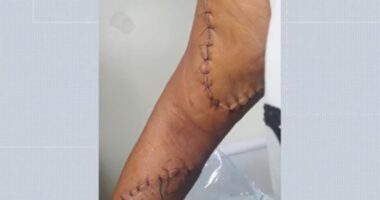 Artigo: Mulher leva mais de 20 pontos no braço após ser apunhalada pelo ex-companheiro